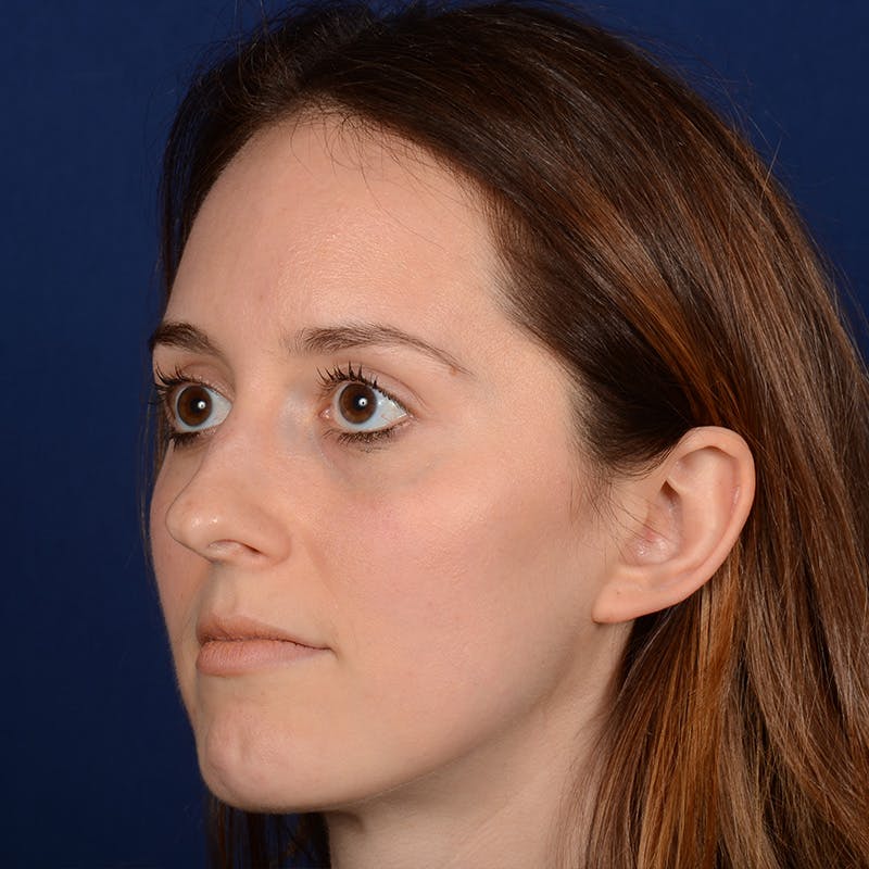 Female Rhinoplasty Before & After Gallery - Patient 389365 - Image 7
