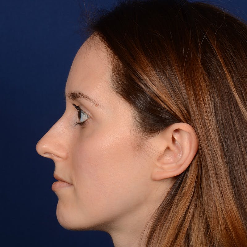 Female Rhinoplasty Before & After Gallery - Patient 389365 - Image 9