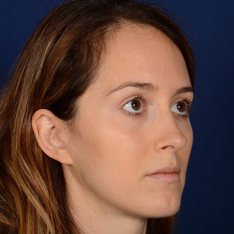 Female Rhinoplasty Before & After Gallery - Patient 389365 - Image 4