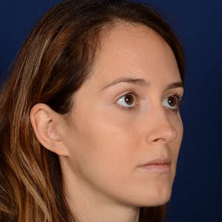 Female Rhinoplasty Before & After Gallery - Patient 389365 - Image 4