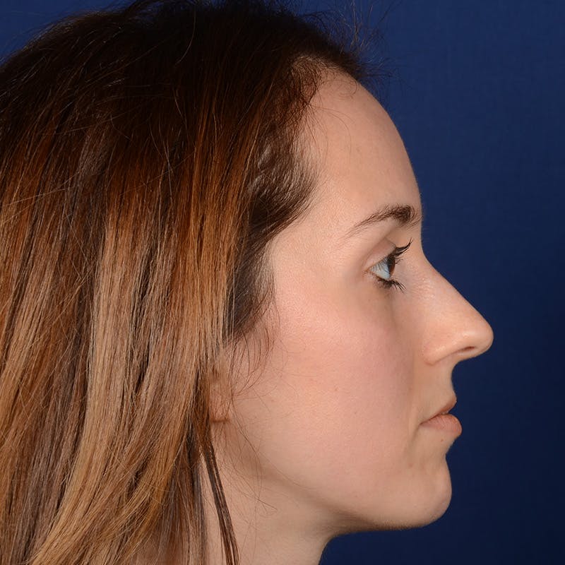 Female Rhinoplasty Before & After Gallery - Patient 389365 - Image 5