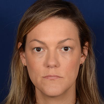 Female Rhinoplasty Before & After Gallery - Patient 258594 - Image 1