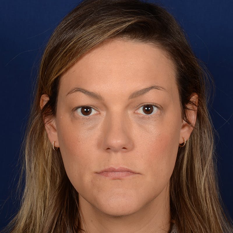 Female Rhinoplasty Before & After Gallery - Patient 258594 - Image 1