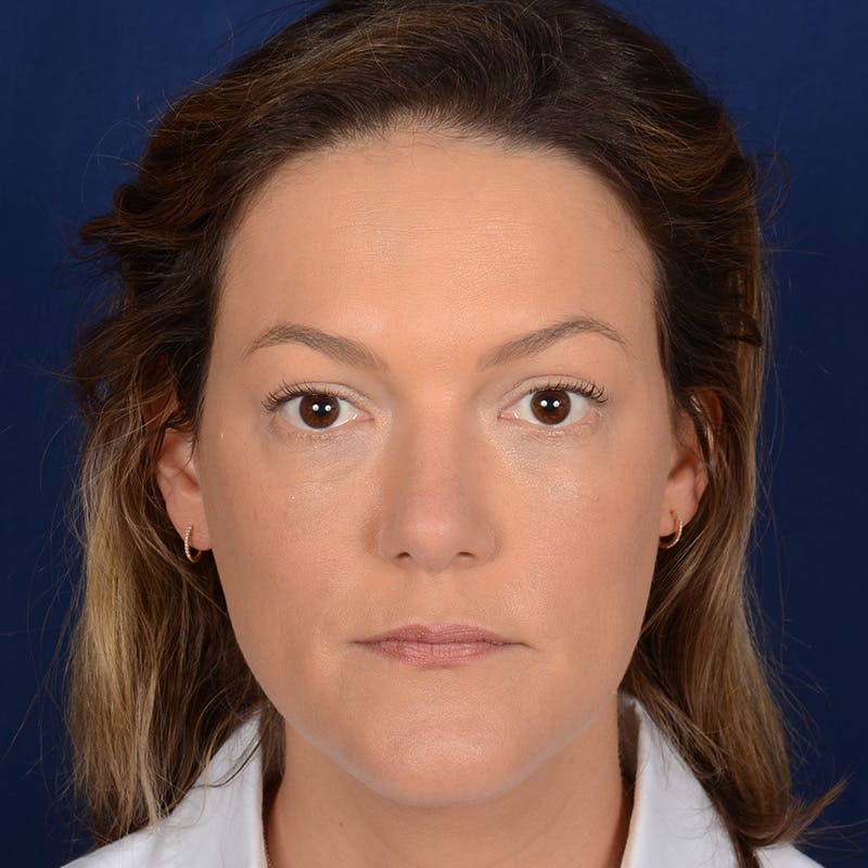 Female Rhinoplasty Before & After Gallery - Patient 258594 - Image 2