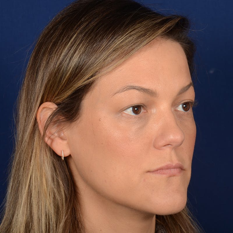 Female Rhinoplasty Before & After Gallery - Patient 258594 - Image 3