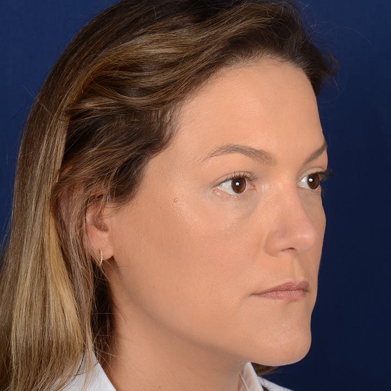 Female Rhinoplasty Before & After Gallery - Patient 258594 - Image 4