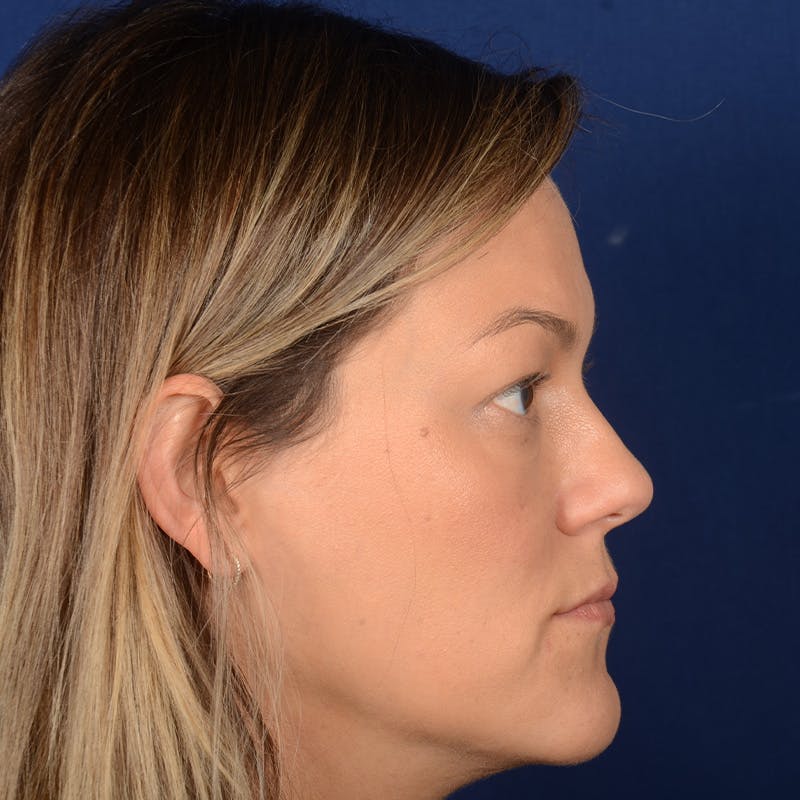 Female Rhinoplasty Before & After Gallery - Patient 258594 - Image 5