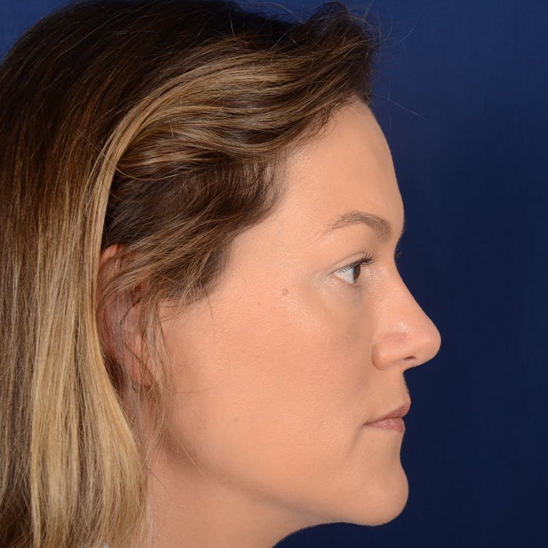 Female Rhinoplasty Before & After Gallery - Patient 258594 - Image 6