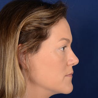Female Rhinoplasty Before & After Gallery - Patient 258594 - Image 6