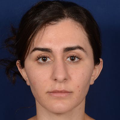 Female Rhinoplasty Before & After Gallery - Patient 192922 - Image 1