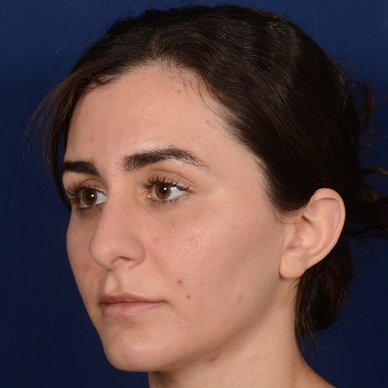 Female Rhinoplasty Before & After Gallery - Patient 192922 - Image 3