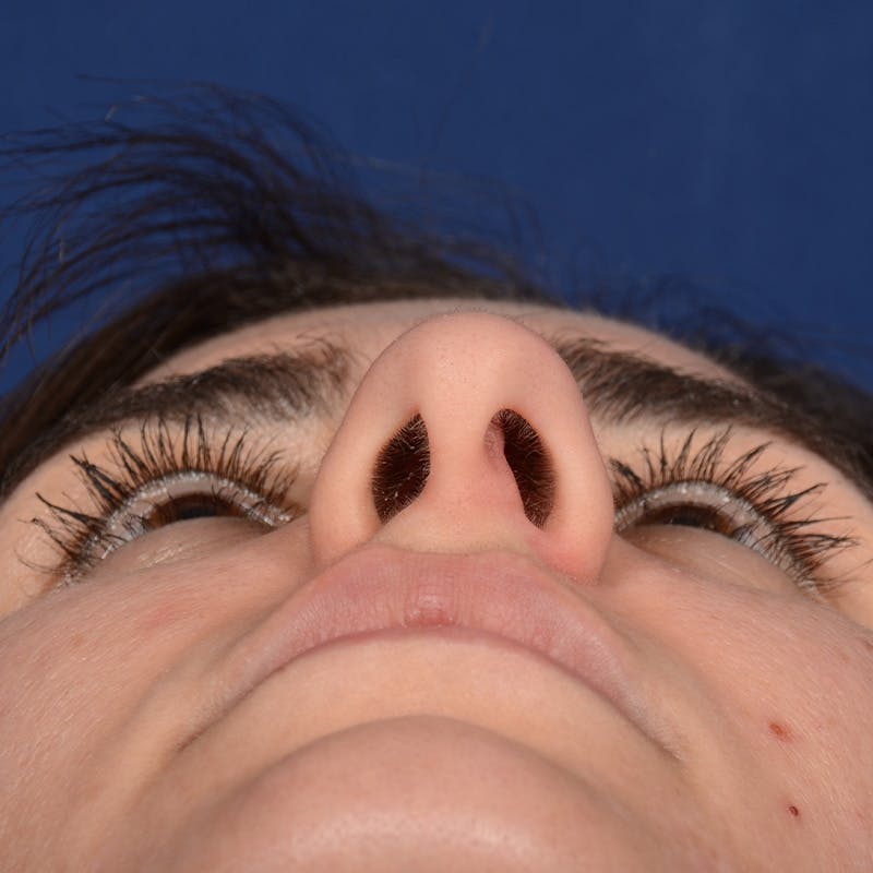 Female Rhinoplasty Before & After Gallery - Patient 192922 - Image 7