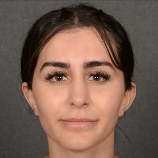 Female Rhinoplasty Before & After Gallery - Patient 192922 - Image 2
