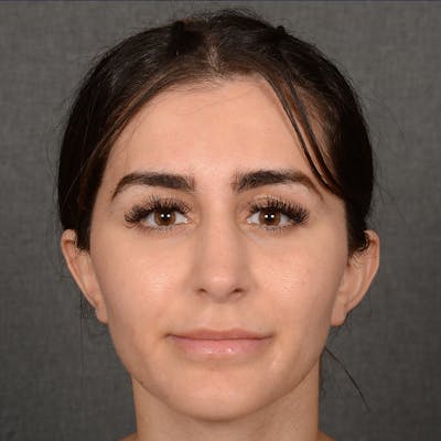 Female Rhinoplasty Before & After Gallery - Patient 192922 - Image 2