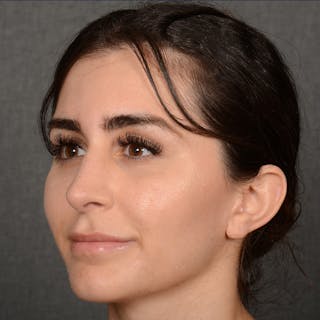 Female Rhinoplasty Before & After Gallery - Patient 192922 - Image 4