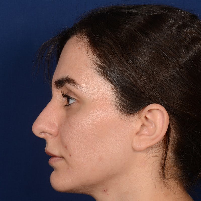 Female Rhinoplasty Before & After Gallery - Patient 192922 - Image 5