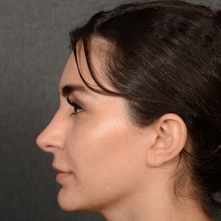Female Rhinoplasty Before & After Gallery - Patient 192922 - Image 6