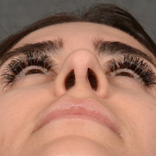 Female Rhinoplasty Before & After Gallery - Patient 192922 - Image 8