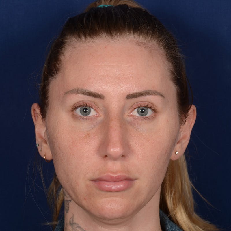 Female Rhinoplasty Before & After Gallery - Patient 755498 - Image 1