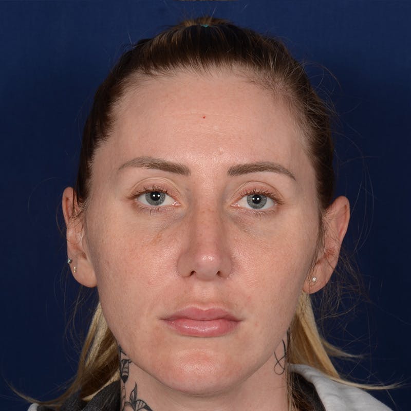Female Rhinoplasty Before & After Gallery - Patient 755498 - Image 2