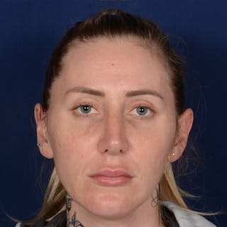 Female Rhinoplasty Before & After Gallery - Patient 755498 - Image 2