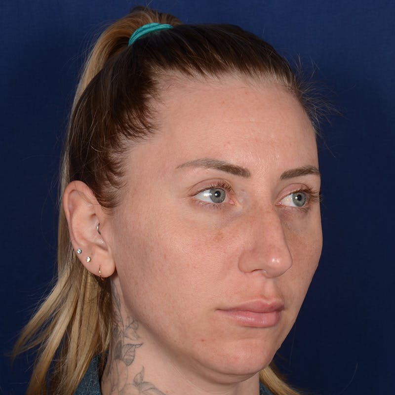 Female Rhinoplasty Before & After Gallery - Patient 755498 - Image 3