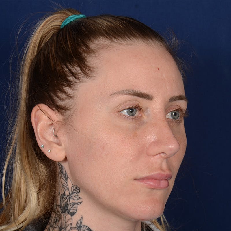Female Rhinoplasty Before & After Gallery - Patient 755498 - Image 4