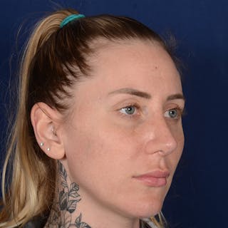 Female Rhinoplasty Before & After Gallery - Patient 755498 - Image 4