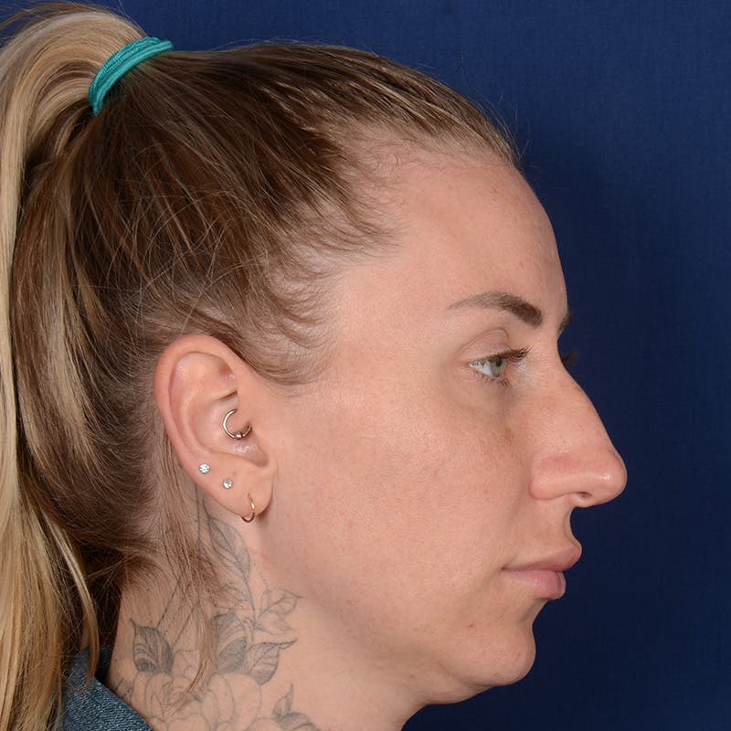 Female Rhinoplasty Before & After Gallery - Patient 755498 - Image 5