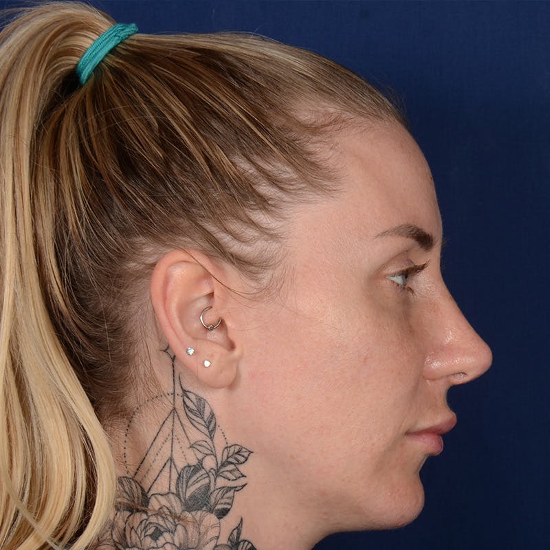 Female Rhinoplasty Before & After Gallery - Patient 755498 - Image 6