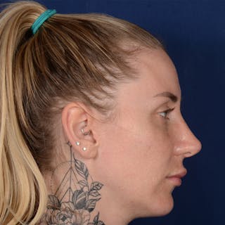 Female Rhinoplasty Before & After Gallery - Patient 755498 - Image 6