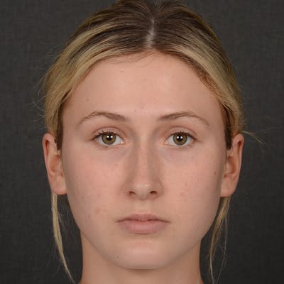 Female Rhinoplasty Before & After Gallery - Patient 252027 - Image 1
