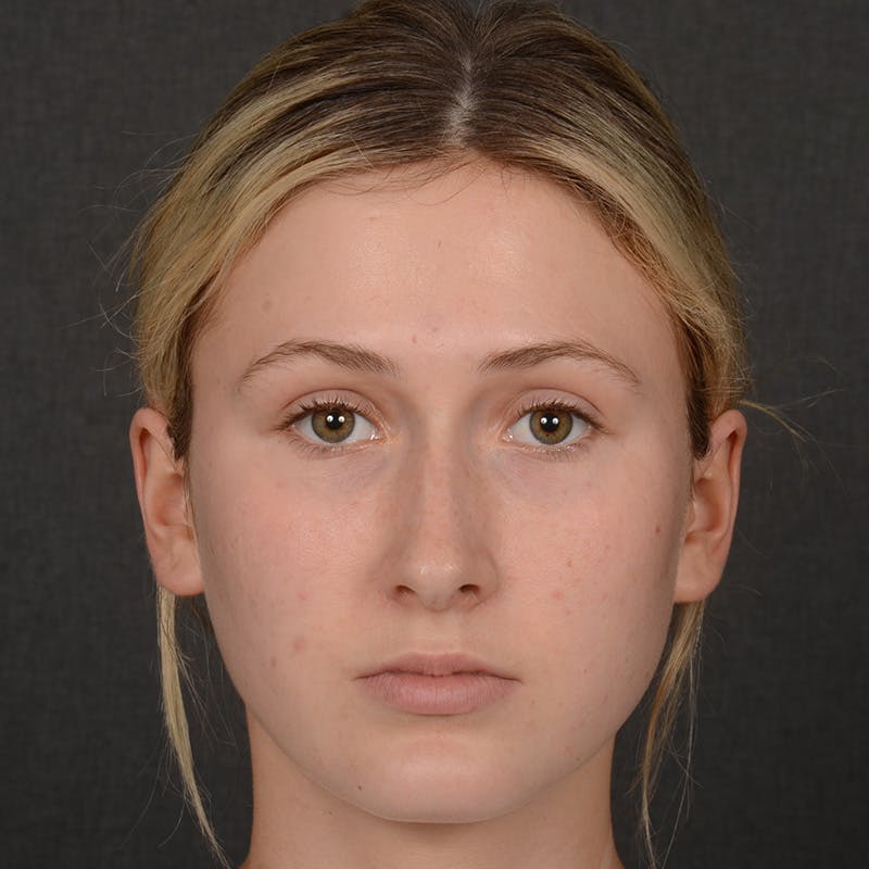 Female Rhinoplasty Before & After Gallery - Patient 252027 - Image 1