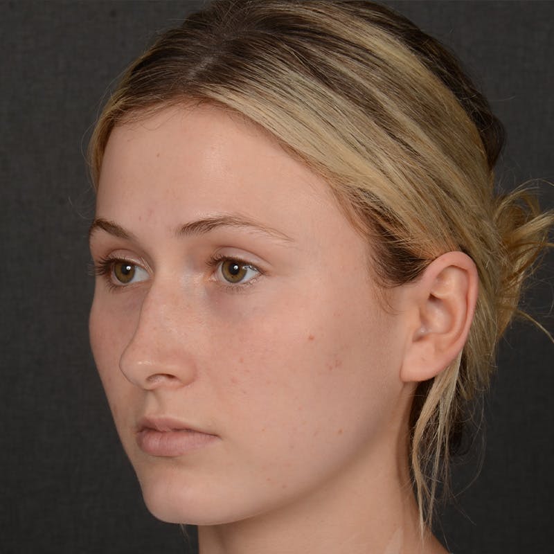 Female Rhinoplasty Before & After Gallery - Patient 252027 - Image 3