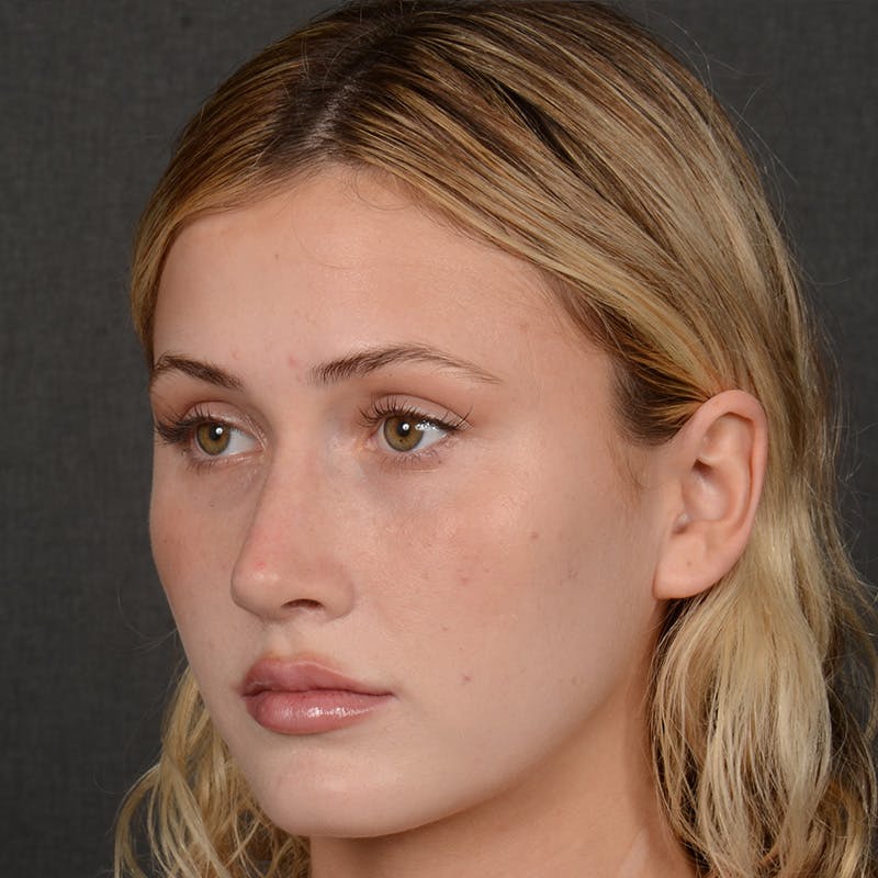 Female Rhinoplasty Before & After Gallery - Patient 252027 - Image 4