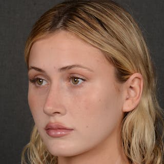 Female Rhinoplasty Before & After Gallery - Patient 252027 - Image 4