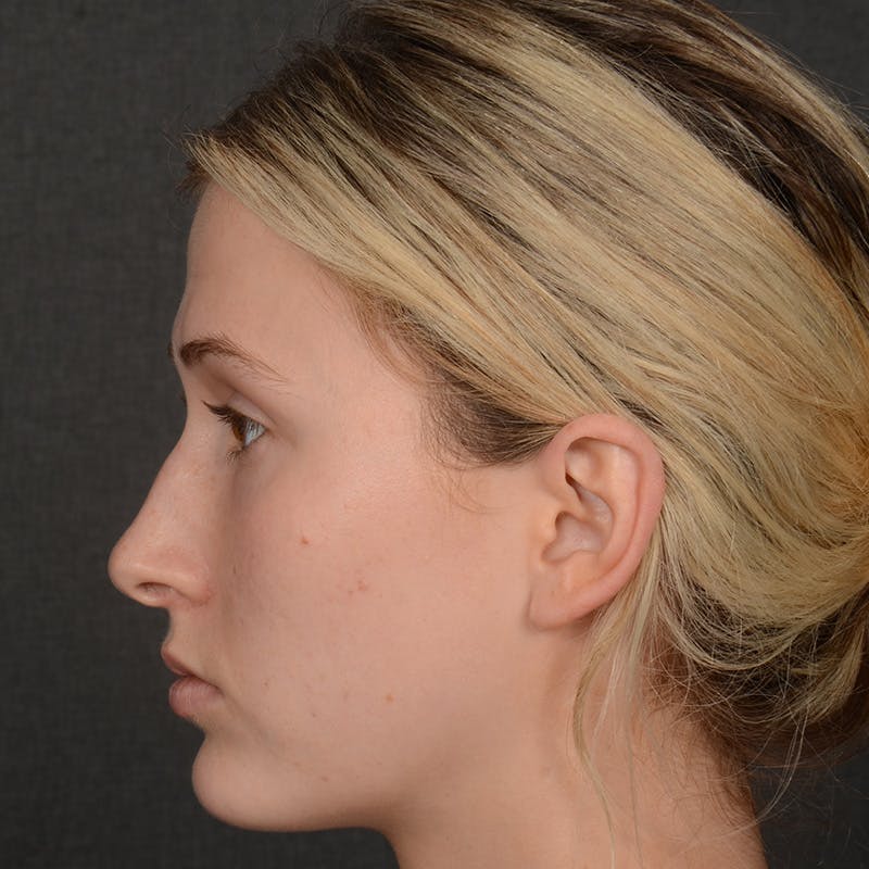Female Rhinoplasty Before & After Gallery - Patient 252027 - Image 5