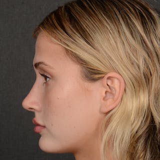 Female Rhinoplasty Before & After Gallery - Patient 252027 - Image 6