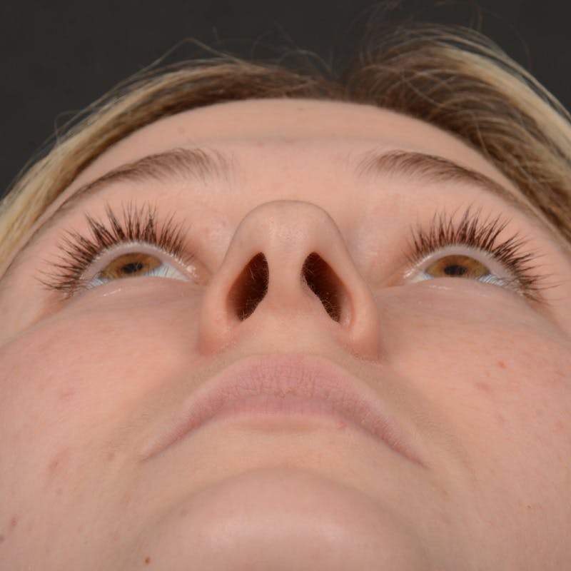 Female Rhinoplasty Before & After Gallery - Patient 252027 - Image 7