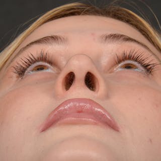Female Rhinoplasty Before & After Gallery - Patient 252027 - Image 8