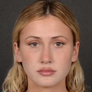 Female Rhinoplasty Before & After Gallery - Patient 252027 - Image 2