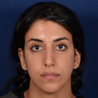 Female Rhinoplasty Before & After Gallery - Patient 143822 - Image 1