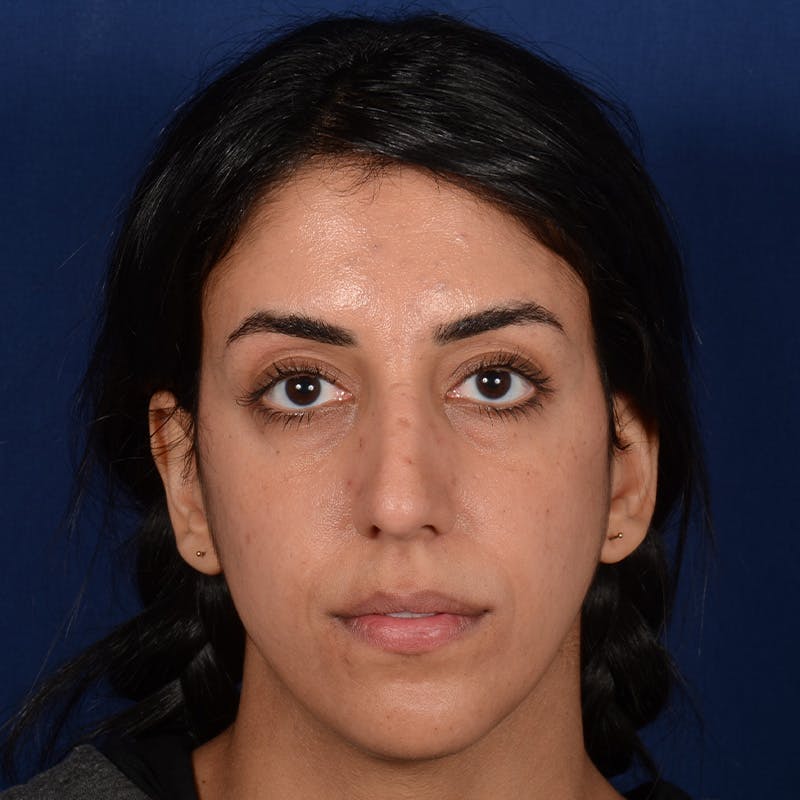 Female Rhinoplasty Before & After Gallery - Patient 143822 - Image 1