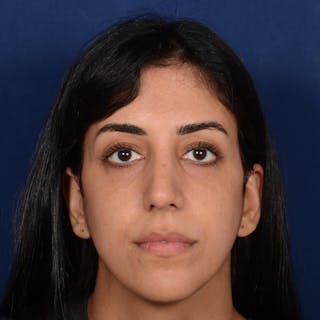 Female Rhinoplasty Before & After Gallery - Patient 143822 - Image 2