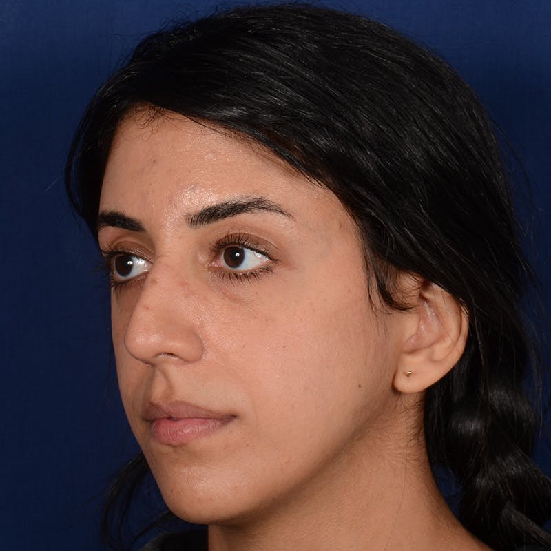 Female Rhinoplasty Before & After Gallery - Patient 143822 - Image 3