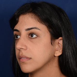 Female Rhinoplasty Before & After Gallery - Patient 143822 - Image 4