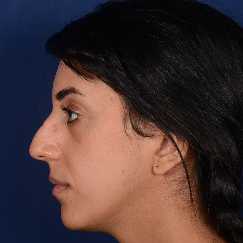 Female Rhinoplasty Before & After Gallery - Patient 143822 - Image 5