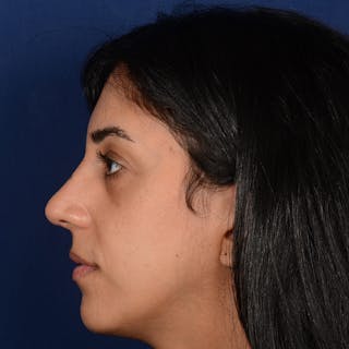 Female Rhinoplasty Before & After Gallery - Patient 143822 - Image 6