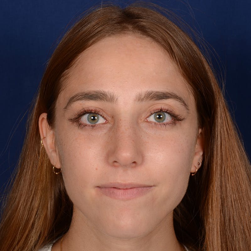 Female Rhinoplasty Before & After Gallery - Patient 146164 - Image 1
