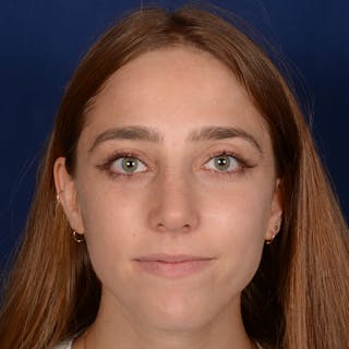 Female Rhinoplasty Before & After Gallery - Patient 146164 - Image 2